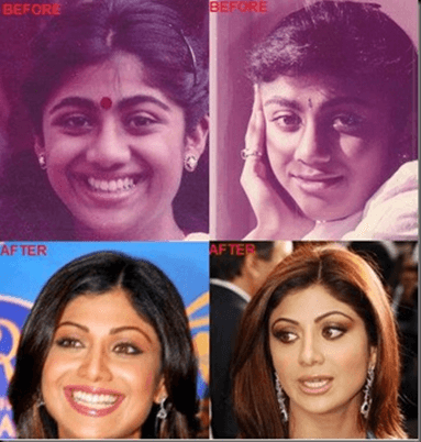  Plastic Surgery on Thread  8 Bollywood Actresses Who Have Undergone Plastic Surgery