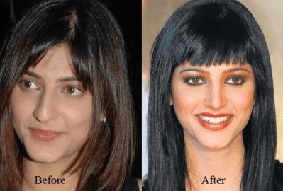 Cosmetic Surgery 8 8 Bollywood Actresses who have Undergone Plastic Surgery