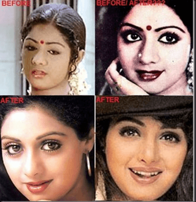 Cosmetic Surgery 9 8 Bollywood Actresses who have Undergone Plastic Surgery