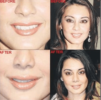 cosmetic surgery 1 Top 10 Bollywood and Hollywood Plastic Surgery Disasters