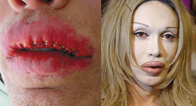 cosmetic surgery 3 Top 10 Bollywood and Hollywood Plastic Surgery Disasters