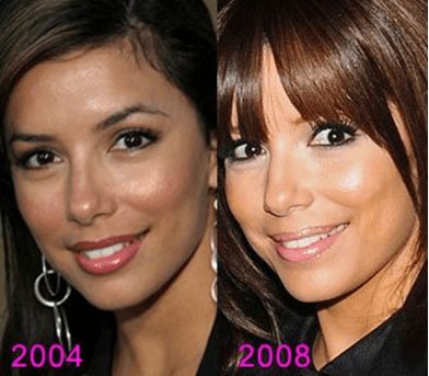 cosmetic surgery 9 Top 10 Bollywood and Hollywood Plastic Surgery Disasters