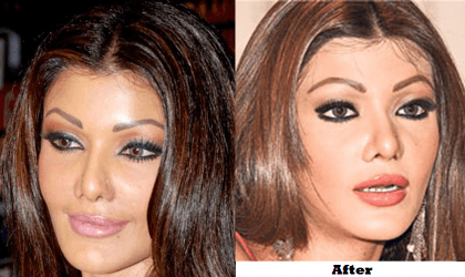 cosmetic surgery Top 10 Bollywood and Hollywood Plastic Surgery Disasters