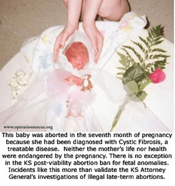PARTIAL BIRTH ABORTION: