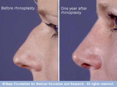 Nose Cosmetic Surgery