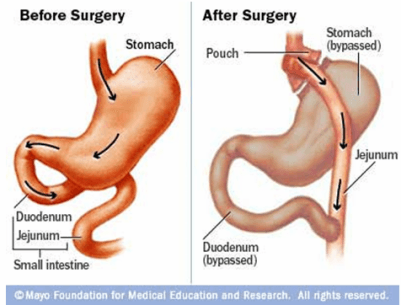 Diagram showing reducing the size of the stomach drastically by bypassing the stomach.
