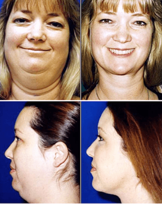 Drastic changes in appearance after liposuction of the chin area.
