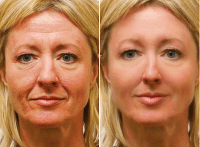 Drastic change after face lift and eye bag surgery.