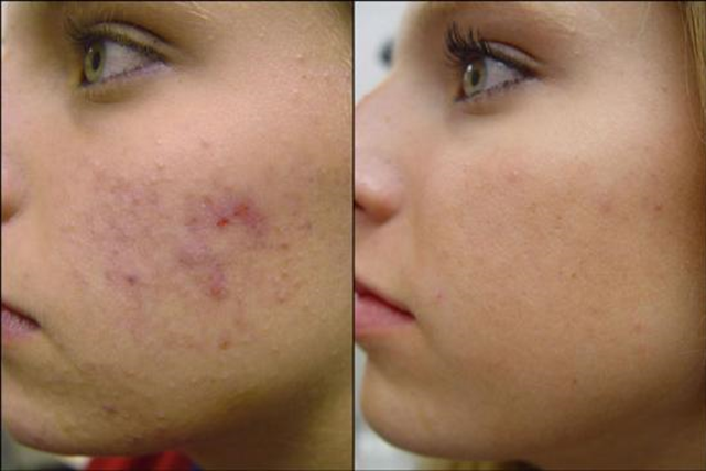 glycolic acid peeling before after
