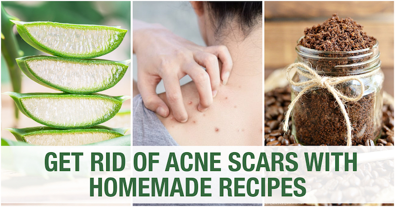 Acne body scars