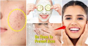 Skin hygiene to prevent acne