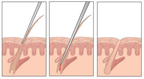 Electrolysis Permanent Hair Removal Procedure - The Best Hair Removal Method