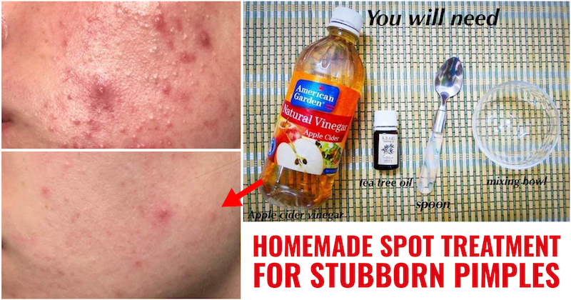 Homemade Spot Treatment For Stubborn Pimples