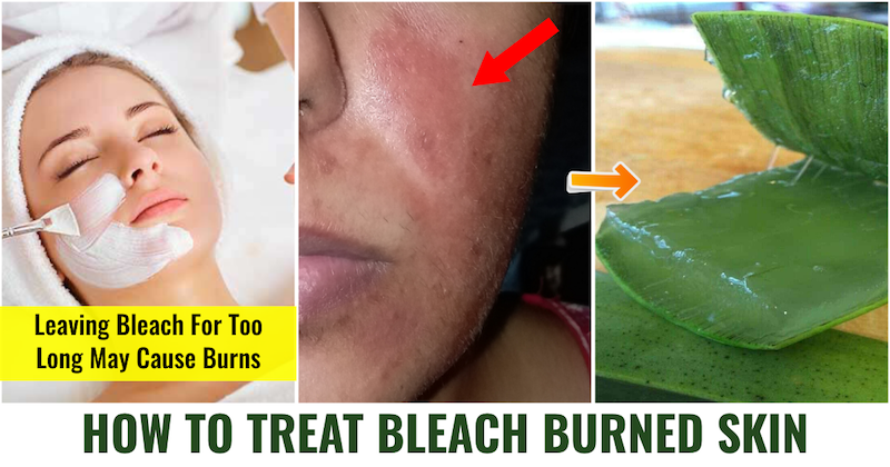 Bleach burned skin