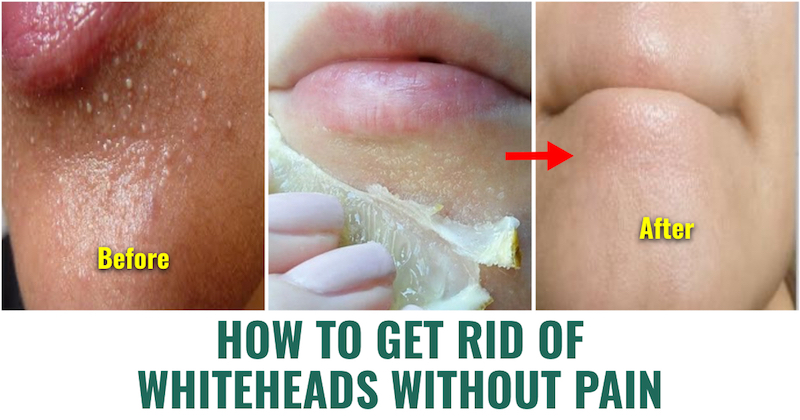 Whiteheads Without Pain