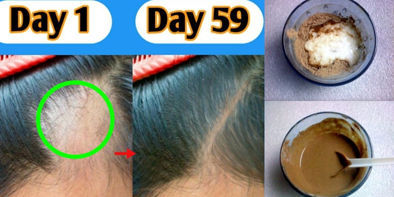 How to Grow Baby Hair on Forehead 