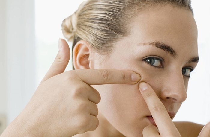 10 Do Nots for Girls with Acne and Pimple-Prone Skin1