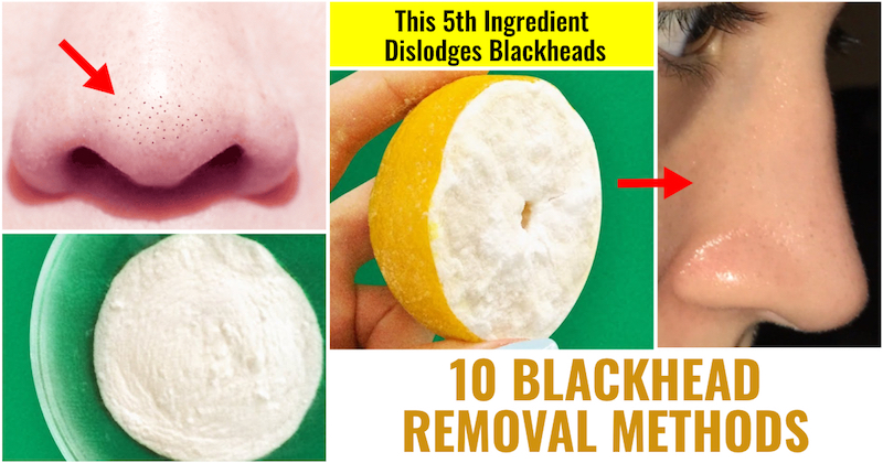 Blackhead removal methods