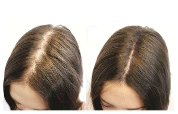 biotin before and after