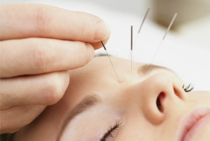 Accupuncture treatment for weight loss
