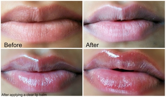 Lip Plumper Before and After