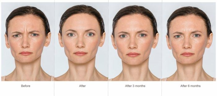 botox results before and after