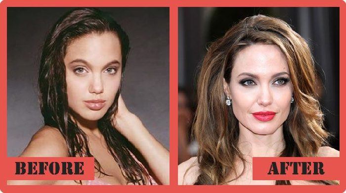 10-celeb-inspired-cosmetic-procedures-that-even-you-can-go-for