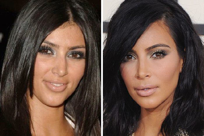 kim-kardashian-facelift