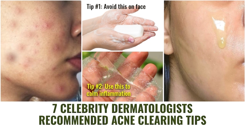 Dermatologist Acne Clearing Tips
