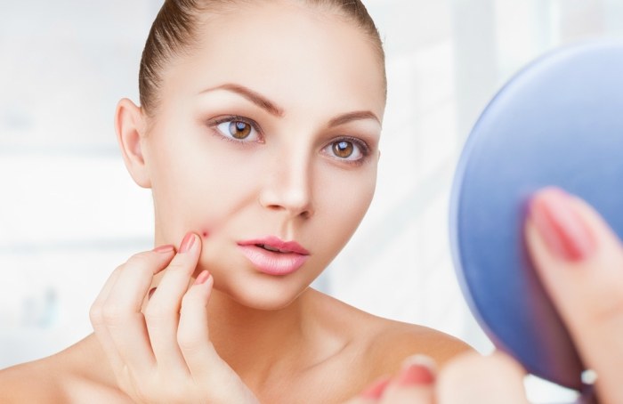 7 Effective Ways to Treat Cystic Acne Easily4