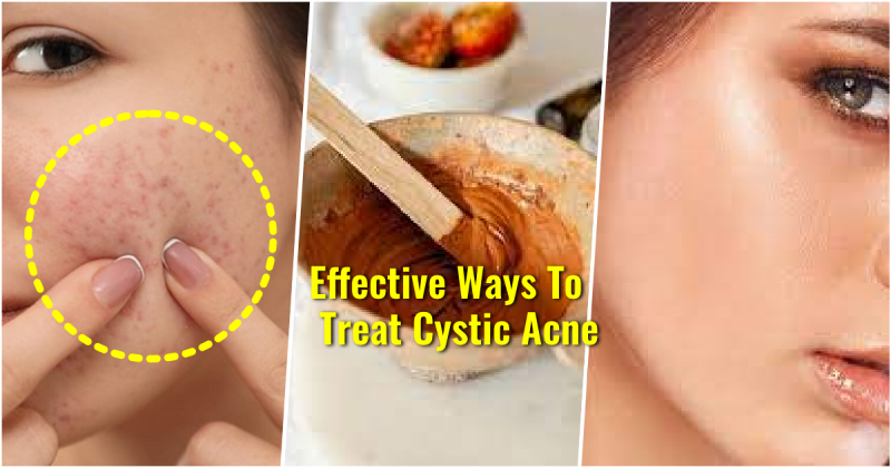 prevent cystic acne