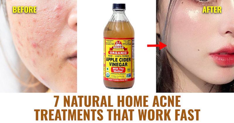 Acne Treatments That Work Fast