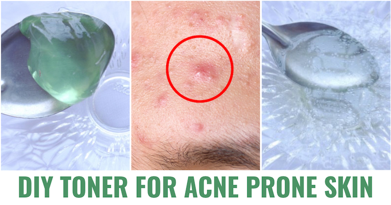 Toner for acne prone skin