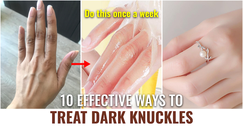 10 Effective Ways to Treat Dark Knuckles 