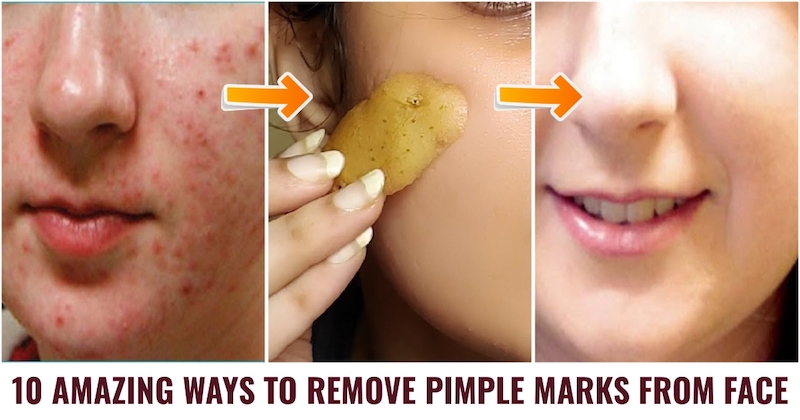 How to Remove Pimple Marks from Face
