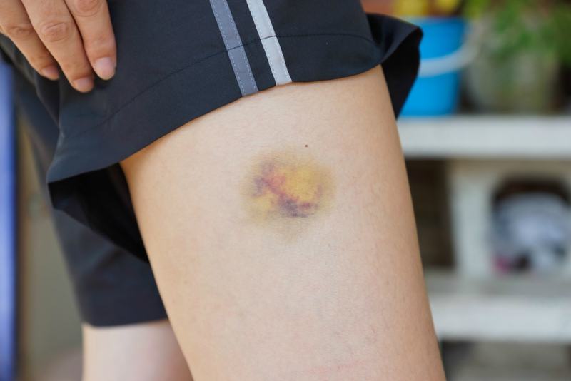 a bruise on woman Thigh