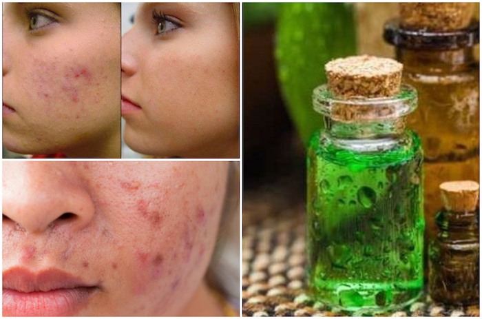 8 Ways to use Tea Tree Oil for Acne and Acne Scars | Makeupandbeauty.com