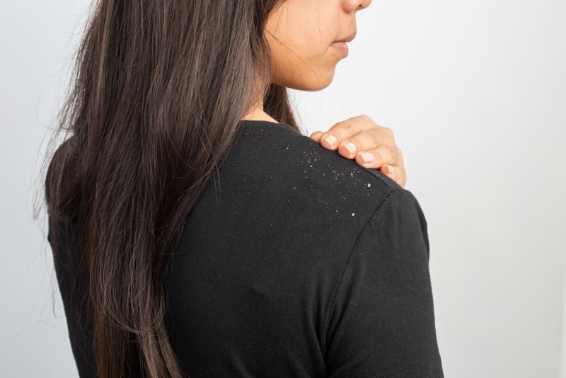 women having dandruff in the hair and shoulder