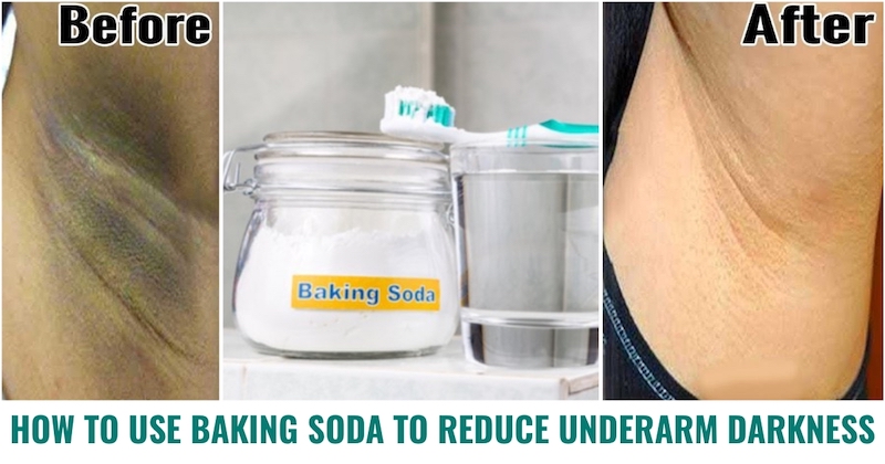 9 Home Remedies Using Baking Soda for Skin and Hair 