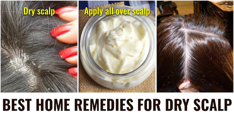 10 Best Home Remedies to Get Rid of Dry Scalp 
