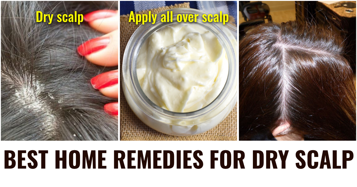 Effective Home Remedies For Dry Scalp - PharmEasy Blog