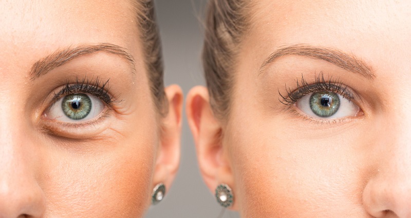 How To Get Rid Of Fine Lines Under Eyes