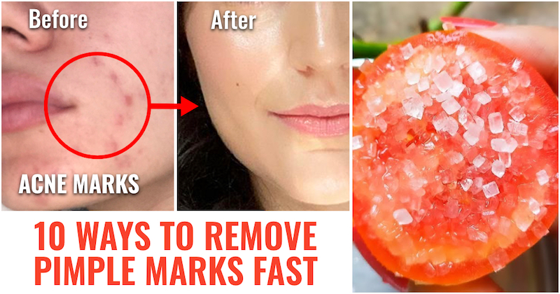 How to Remove Pimple Marks Fast