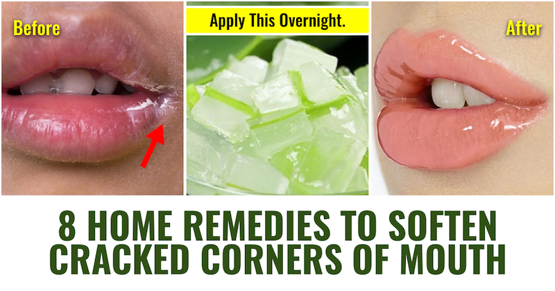 Home line on pimple remedies lip Home Remedies