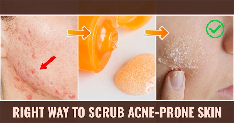 Scrub Acne Prone Skin