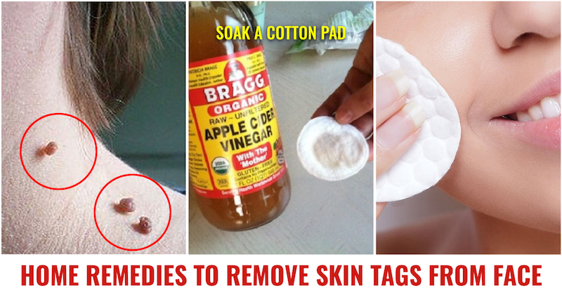 Skin tag removal remedies