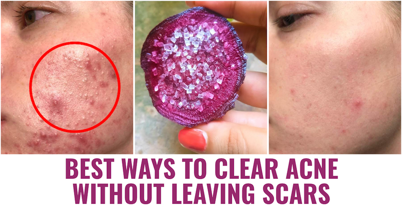 Clear Acne Scars