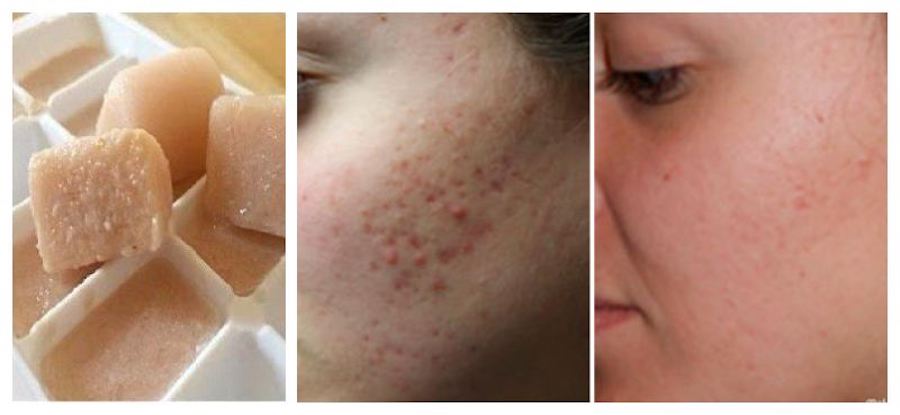 acne spot remover