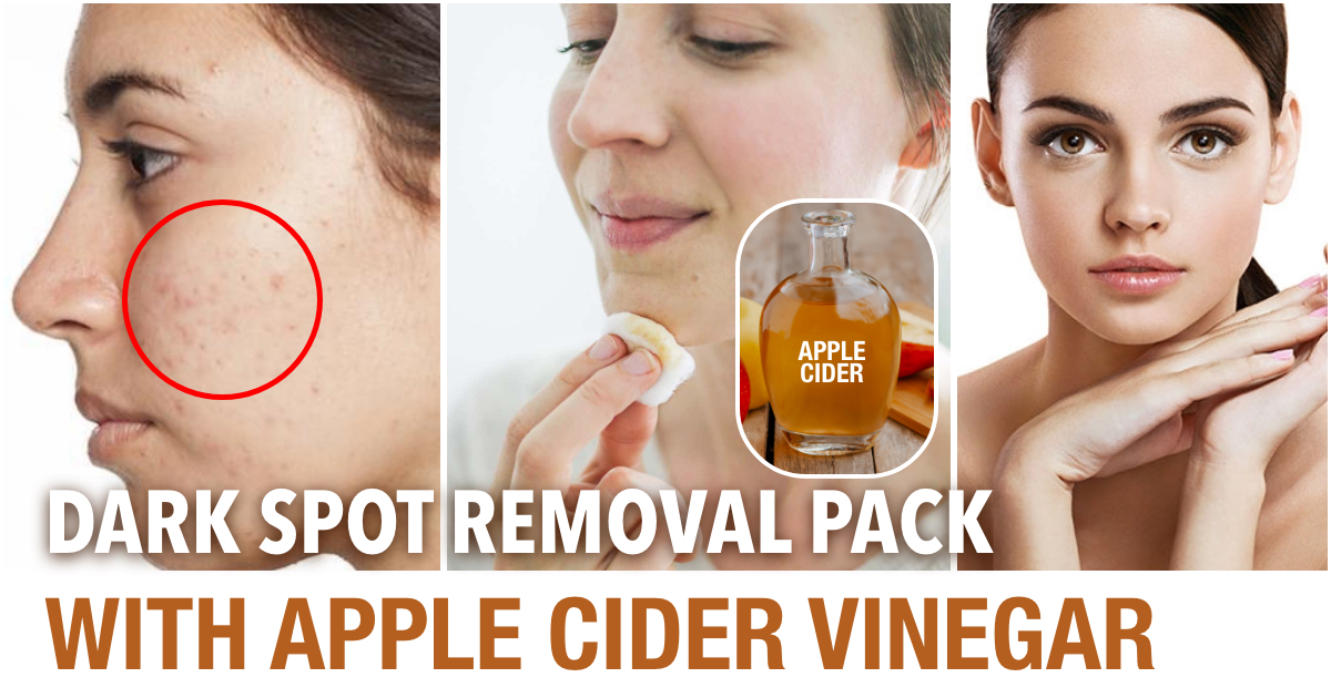 5 Ways To Use Apple Cider Vinegar To Get Rid Of Acne and Dark Spots |  