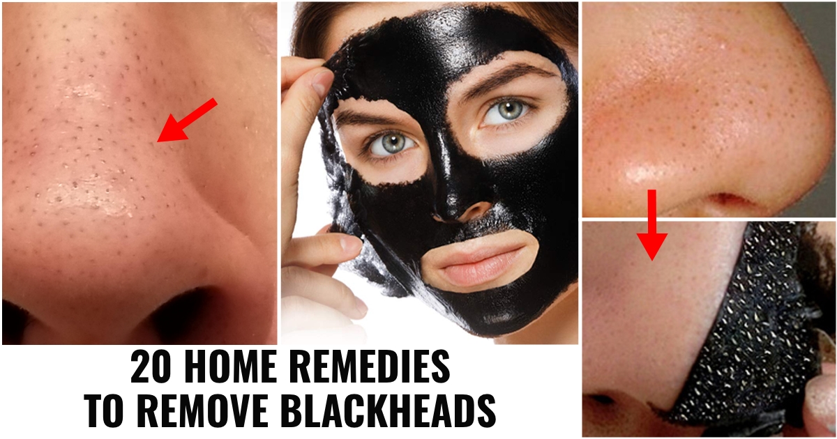 blackhead removal